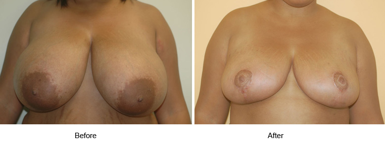 BREAST REDUCTION