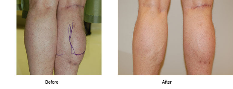 calf implants before and after