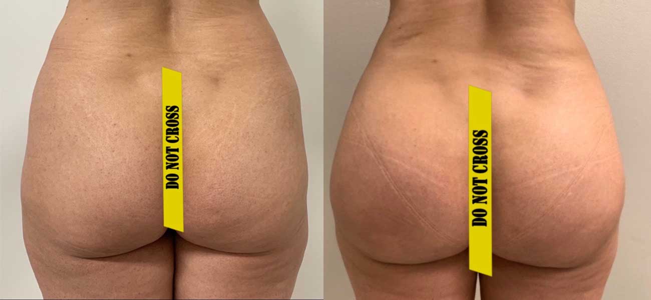 Before and after buttock enhancement