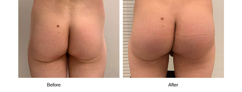 Male Buttock Implants