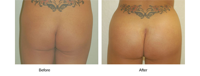 butt implants before and after