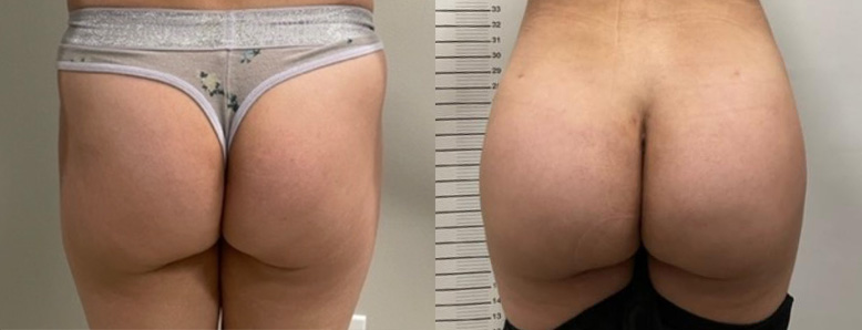 Buttock Implants with Fat Graft