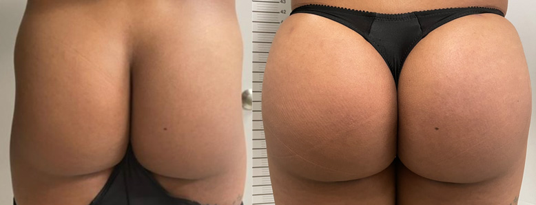 Transgender Woman with Buttock Implants