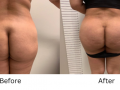 Buttock implants and body contouring
