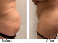 Buttock implants and body contouring