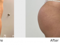 Hip and Butt Augmentation