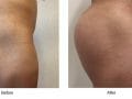 buttock-implant-augmentation