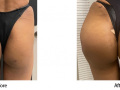 transgender female with hip and Buttock implants