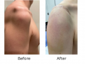 Patient with deltoid atrophy following injury