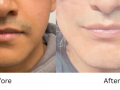 Wrap around mandible