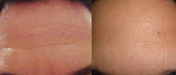 MICRONEEDLING for wrinkled forehead