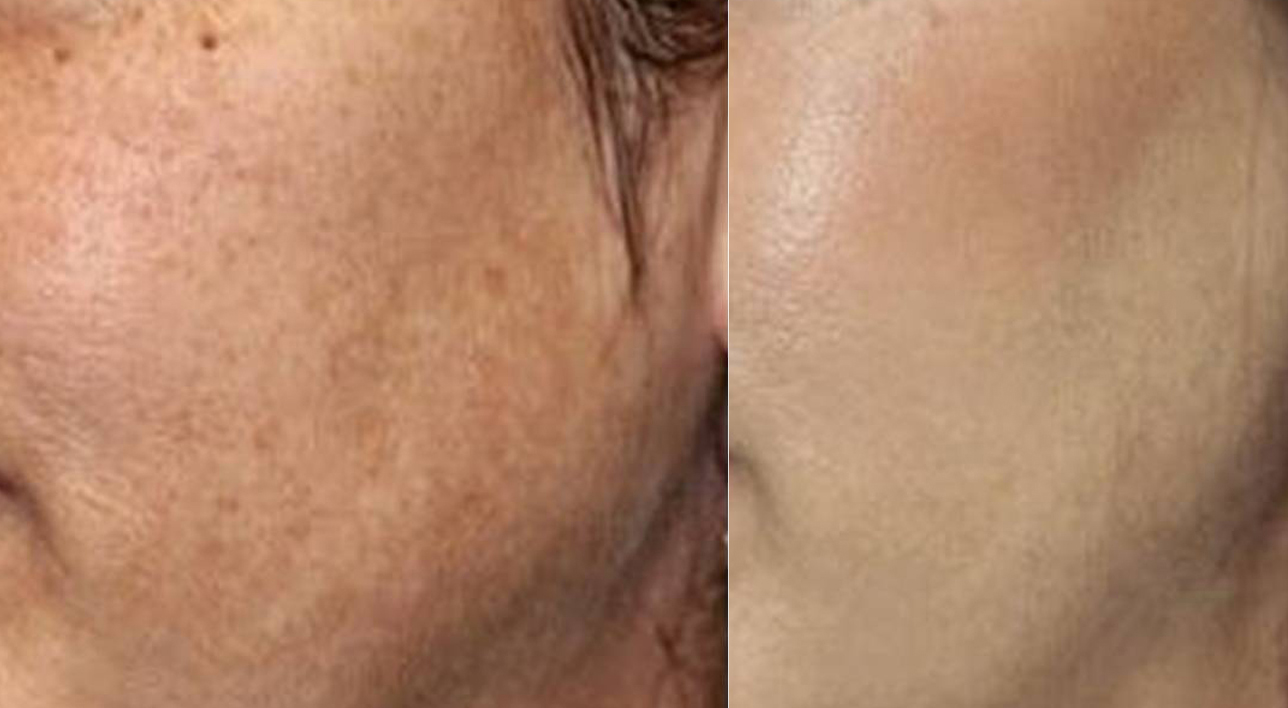 MICRONEEDLING for Pigment