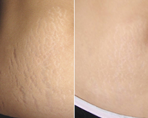 MICRONEEDLING for stretch marks