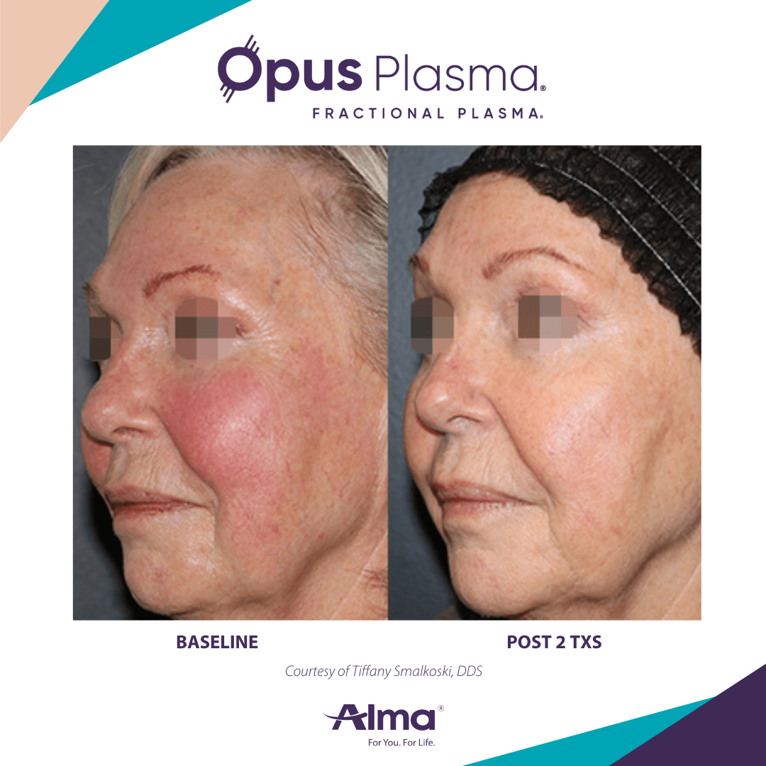 opus-plasma-rejuvenation-before-and-after-10
