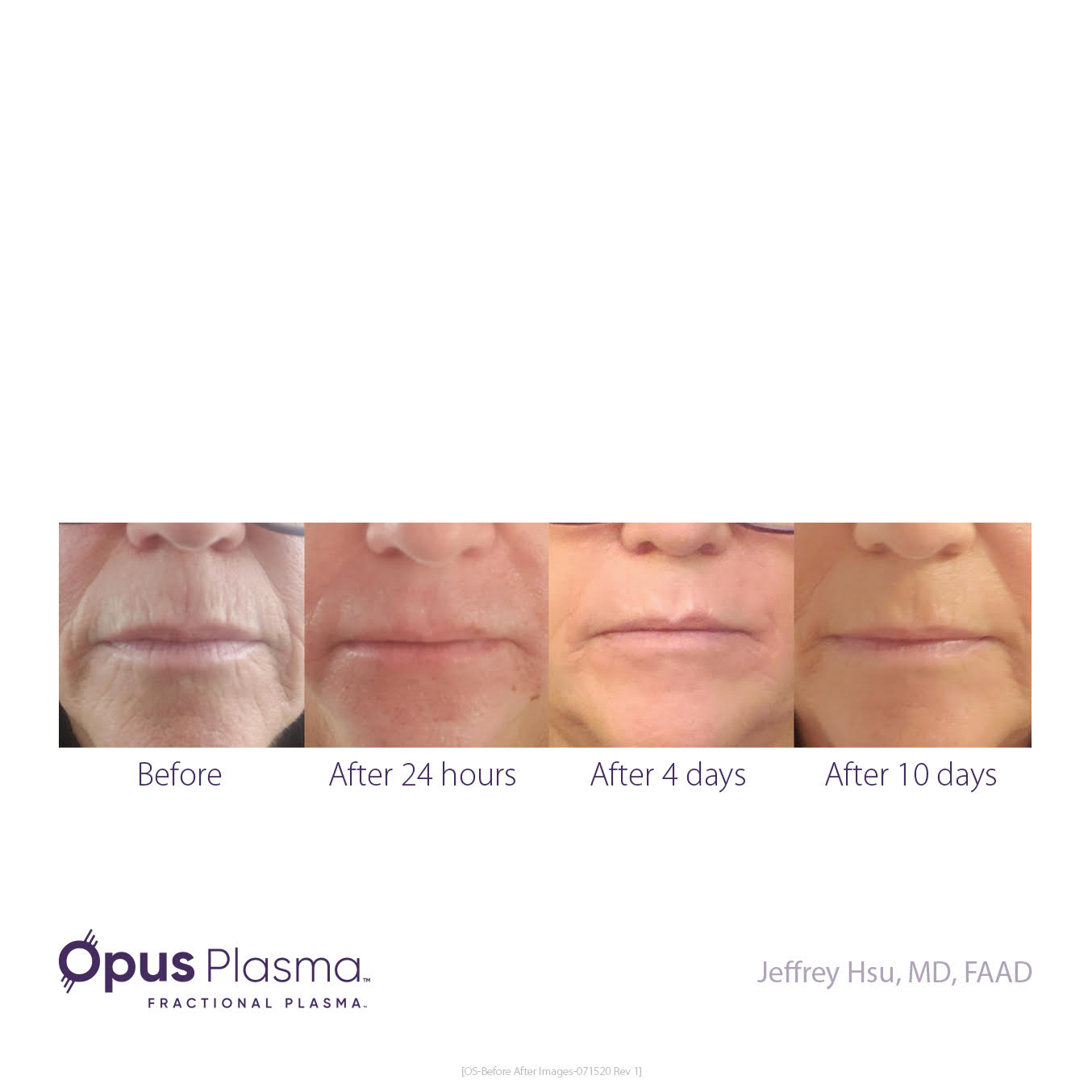 opus-plasma-rejuvenation-before-and-after-2