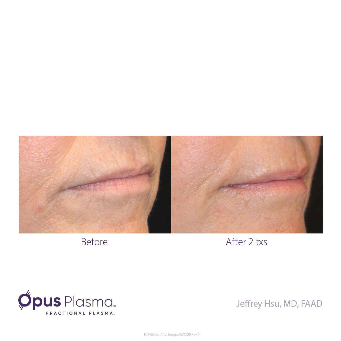 opus-plasma-rejuvenation-before-and-after-4
