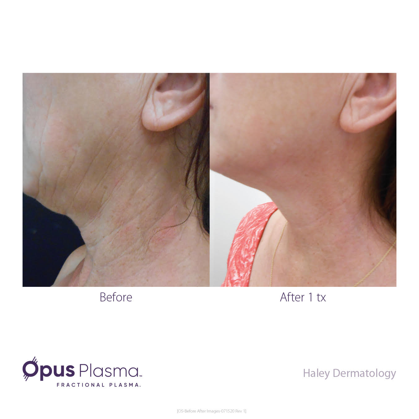 opus-plasma-rejuvenation-before-and-after-5