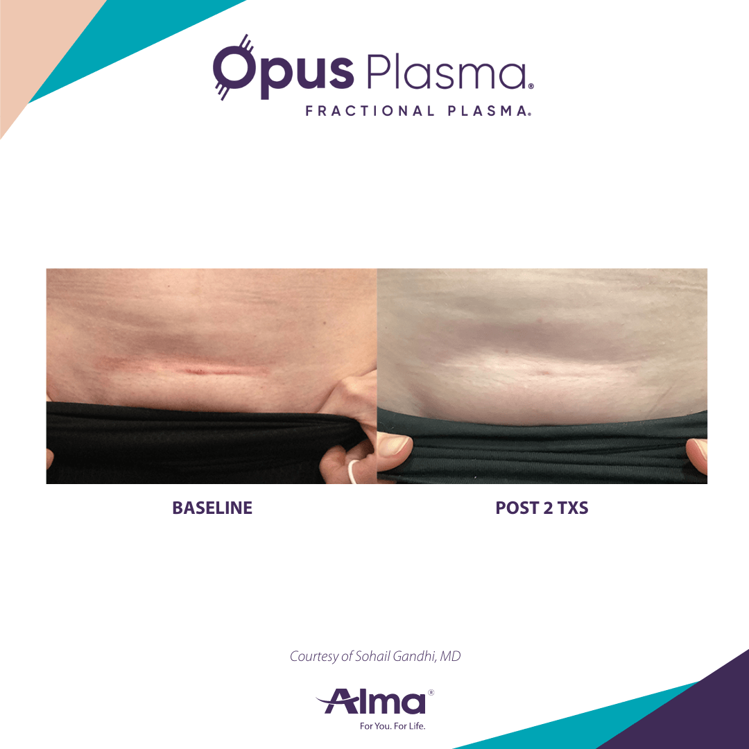 opus-plasma-rejuvenation-before-and-after-7