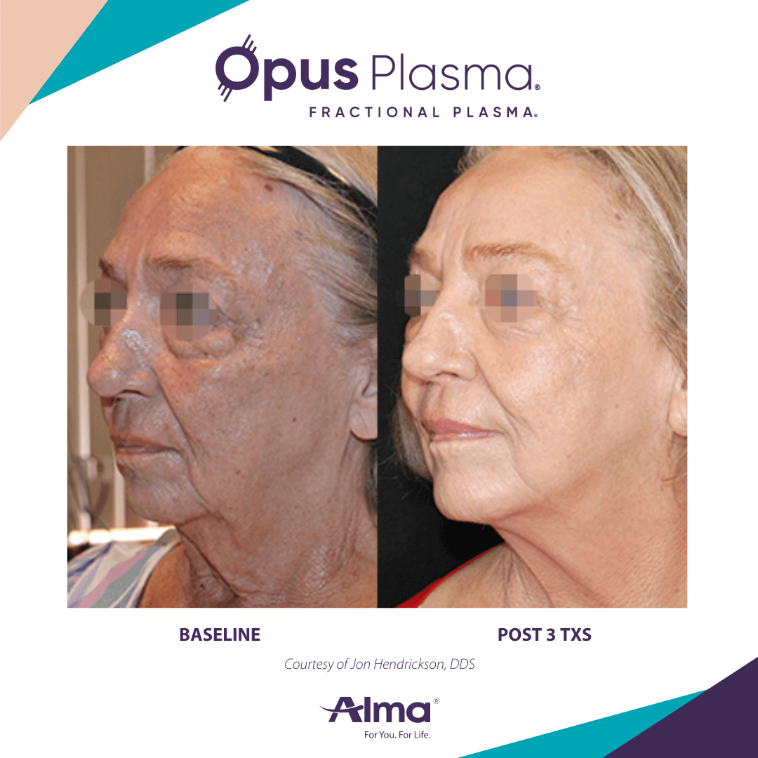 opus-plasma-rejuvenation-before-and-after-9