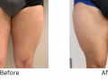 Thigh Implants