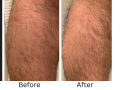 Thigh Implants