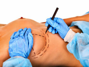 breast lift procedure