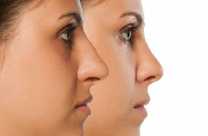 rhinoplasty-san-francisco