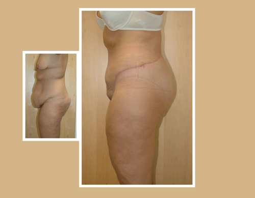 bodylift before and after photos