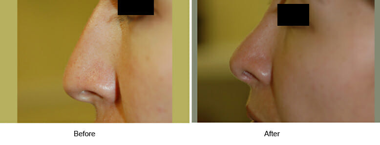 BEFORE & AFTER RESULTS OF Rhinoplasty Surgery