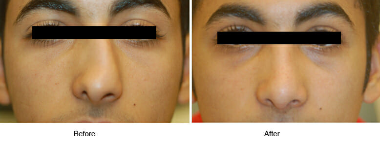 San Francisco Rhinoplasty