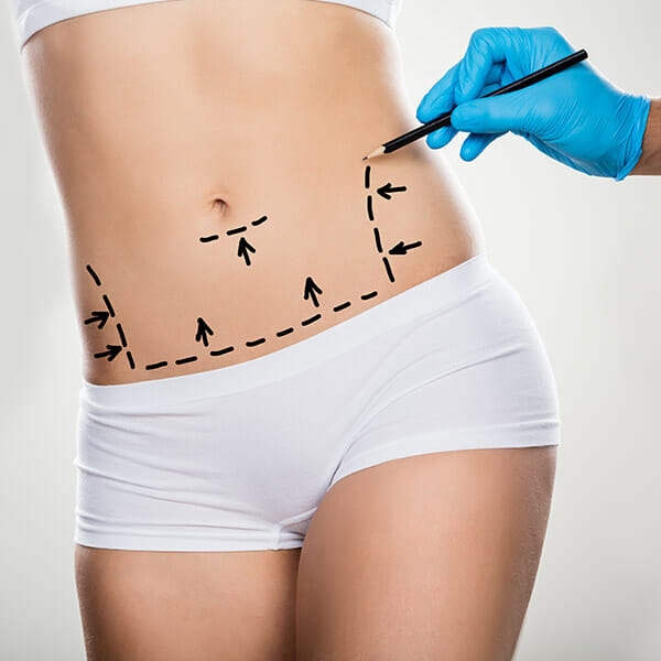 tummy tuck