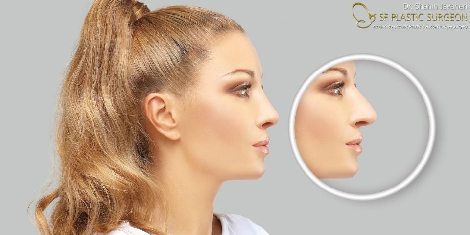 2023 How Much Does A Rhinoplasty Cost in California? Nose Job Price