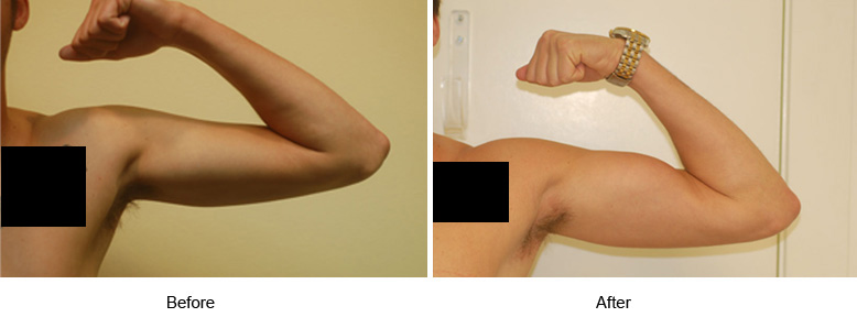 Biceps And Triceps Implants Photos, New York, NY