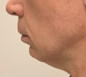 Chin Implant Before