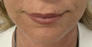 Chin Implant After