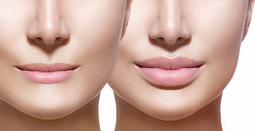 Lip augmentation