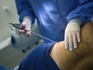 Plastic Surgery Procedures