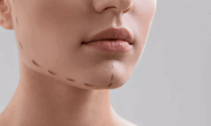 Chin plastic surgery