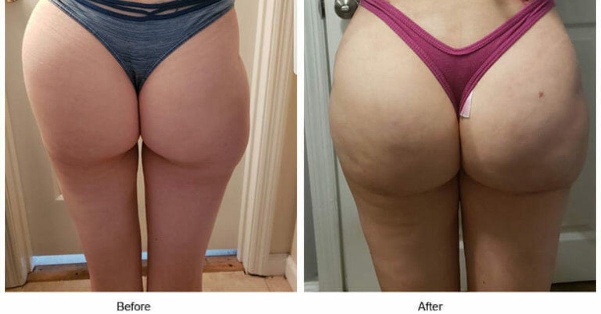 hip and thigh augmentation