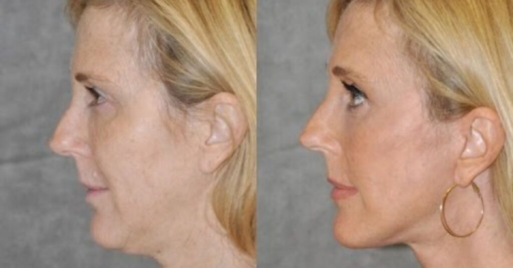 Mini Facelift vs. Full Facelift in San Francisco